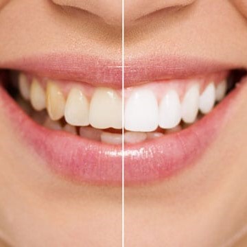 teethwhitening